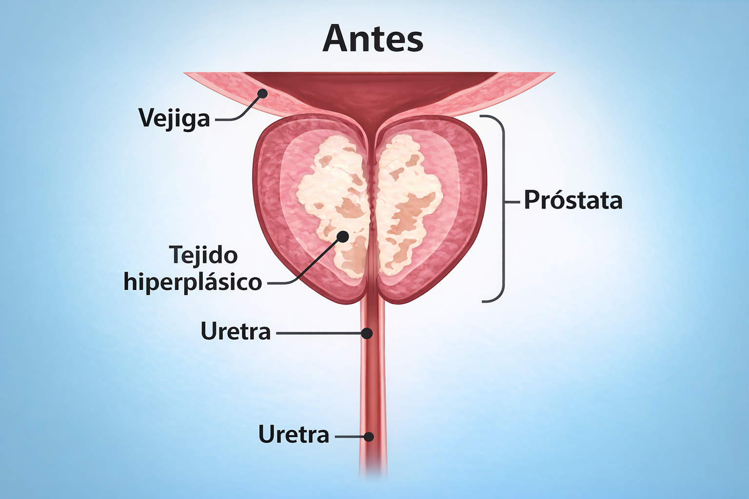 Antes-Rezum