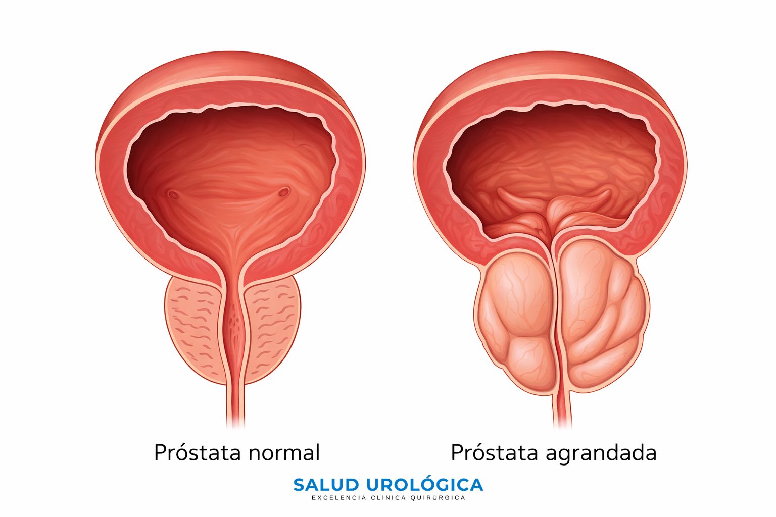 Explicación visual de próstata aumentada y síntomas urinarios
