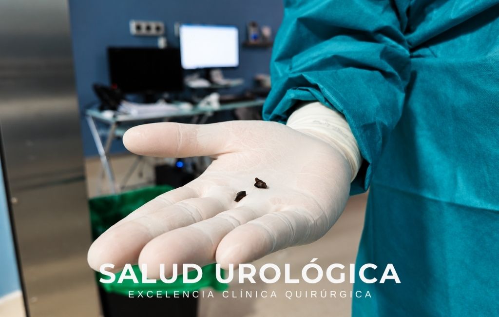 Fragmentos de cálculos urinarios extraídos tras el tratamiento de una litiasis